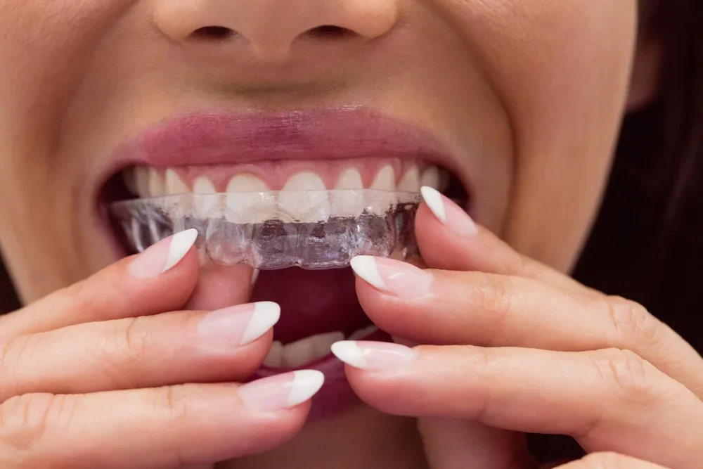 Invisible Dental Corrections: The New Luxury in Grooming