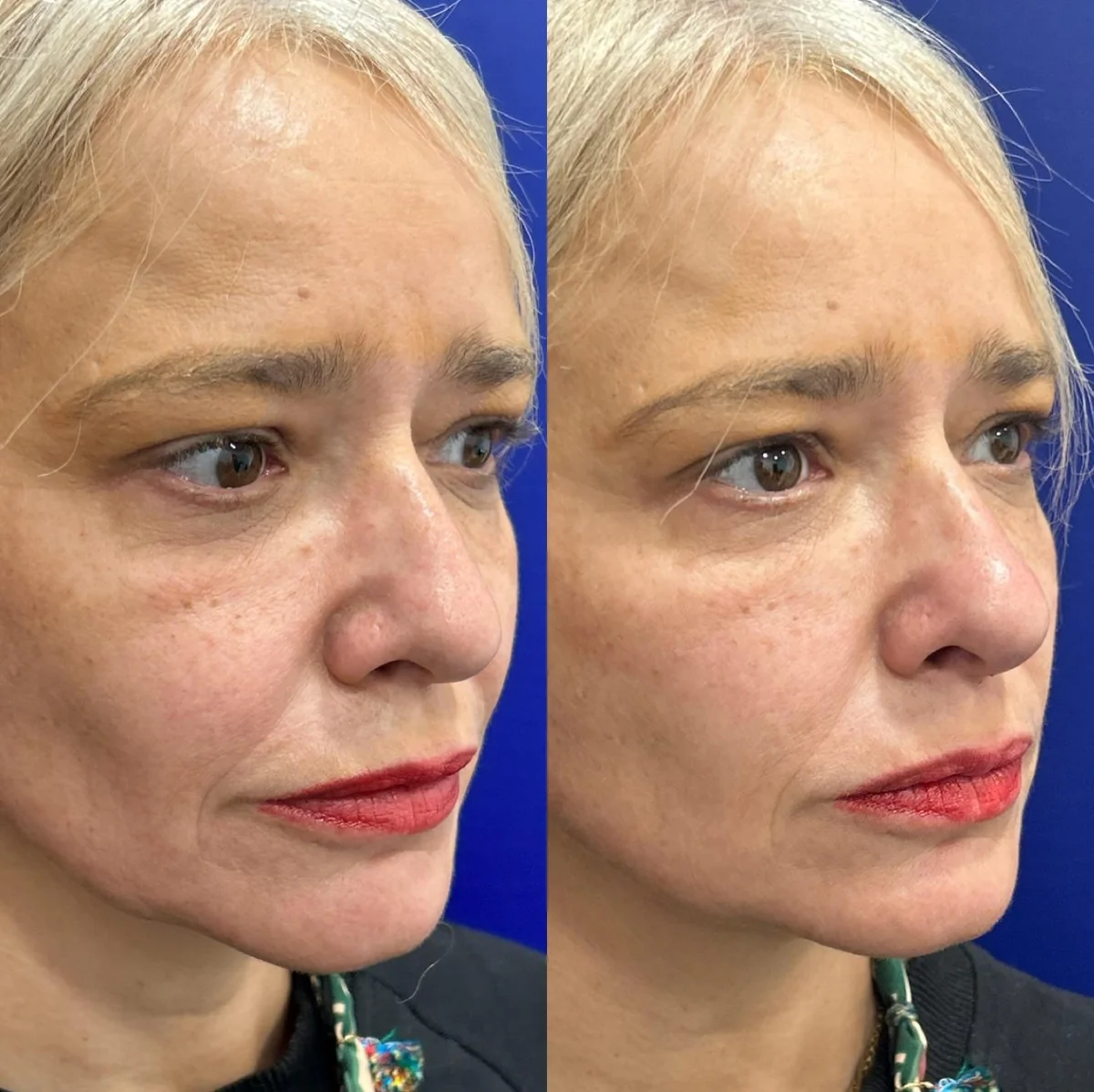 My Experience with Neuromodulators at Clínica Menorca: Less is More